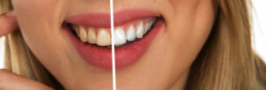 beneficios del blanqueamiento dental en Madrid