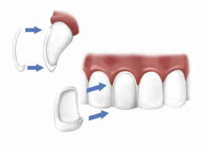 carillas dentales ventajas 