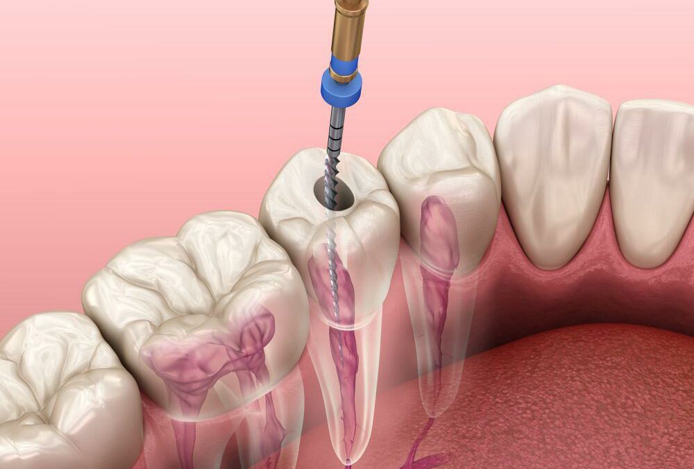 la endodoncia por qué se realiza y en qué consiste