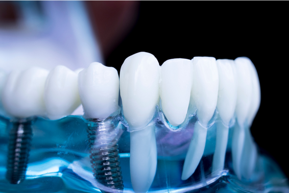 cuidados implantes dentales
