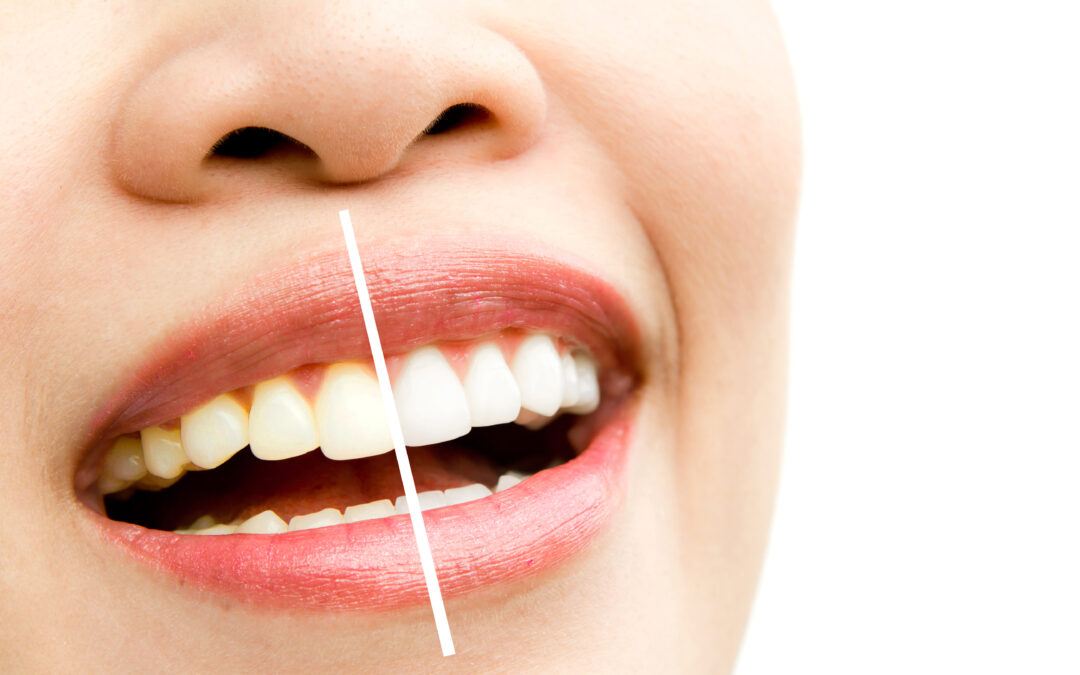 Blanqueamiento dental en Madrid, un aire fresco para tu sonrisa
