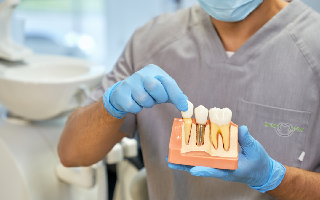 Partes del implante dental y sus cuidados