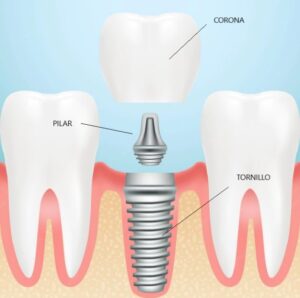 partes del implante dental y sus cuidados