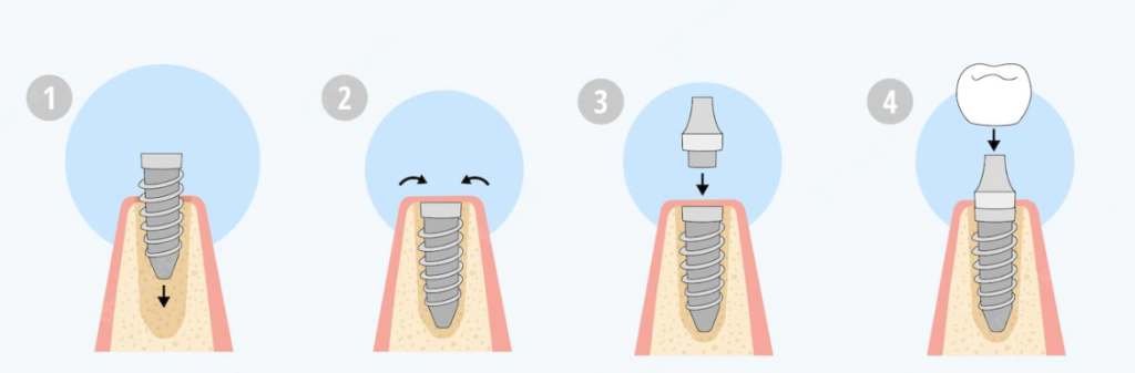 procedimiento colocacion de implantes dentales