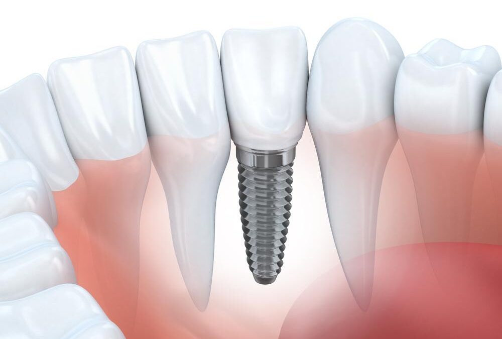 10 preguntas sobre los implantes dentales
