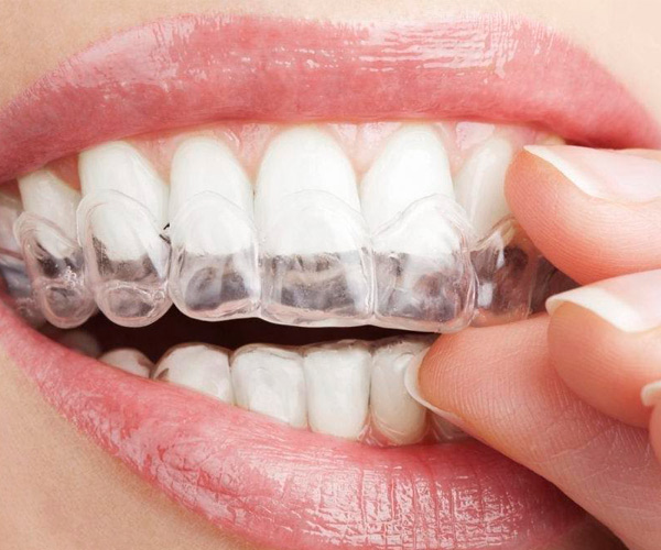 Ventajas de la Ortodoncia Invisible | Invisalign