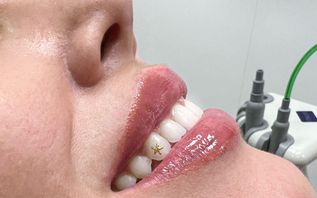 Piercing dental