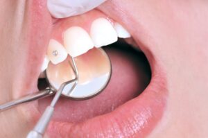 piercing dental dentista diamante