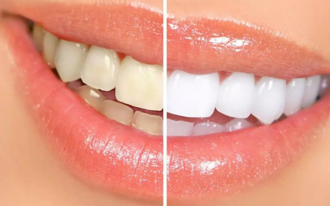 Blanqueamiento dental antes y despues