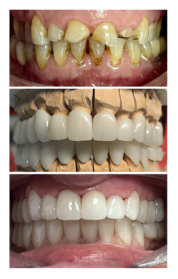 Caso Real Transformación Total de la Sonrisa con Fundas de Zirconio o Disilicato: