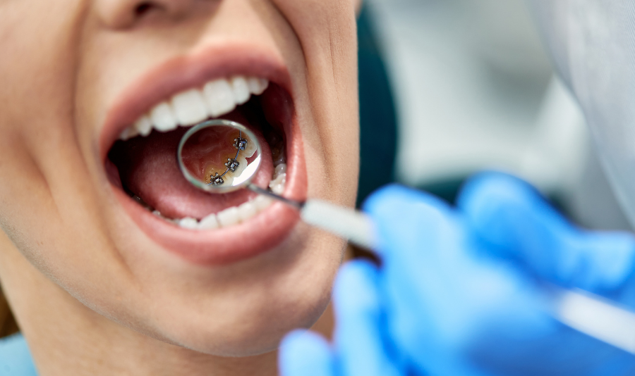 Ortodoncia Lingual en Madrid Alineamiento Dental Discreto y Efectivo